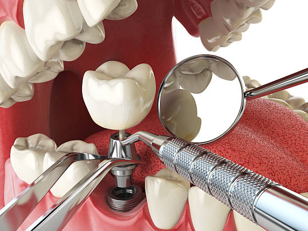 Best Emergency Dentist for Lost Fillings or Crowns in Gberts, IL